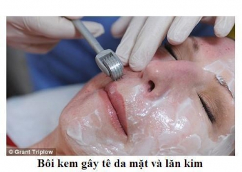 Chi phí một lần lăn kim là bao nhiêu? - Làm đẹp