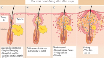 Dịch vụ Spa Ngân Hà điểm trị mụn hoàn hảo - Làm đẹp